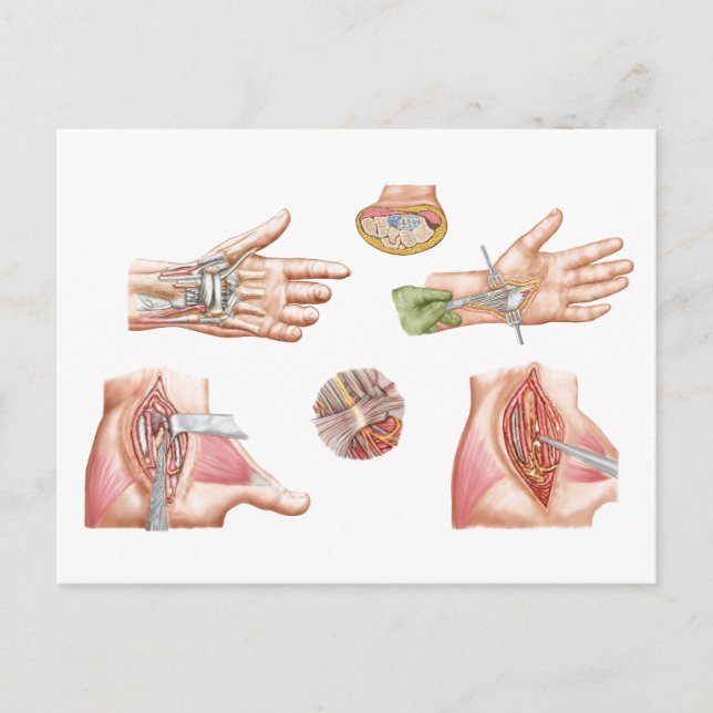 Medical Illustration Showing Carpal Tunnel Postcard (Front)
