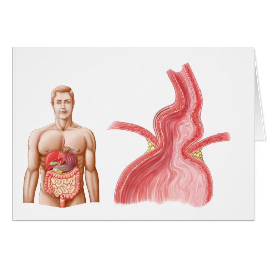 Medical Ilustration Of A Hiatal Hernia In The (Front Horizontal)