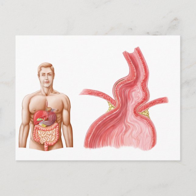 Medical Ilustration Of A Hiatal Hernia In The Postcard (Front)