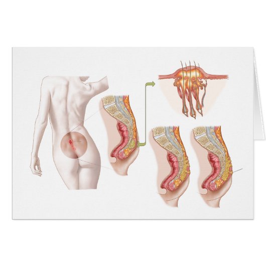 Medical Ilustration Of A Pilonidal Cyst Cards (Front Horizontal)