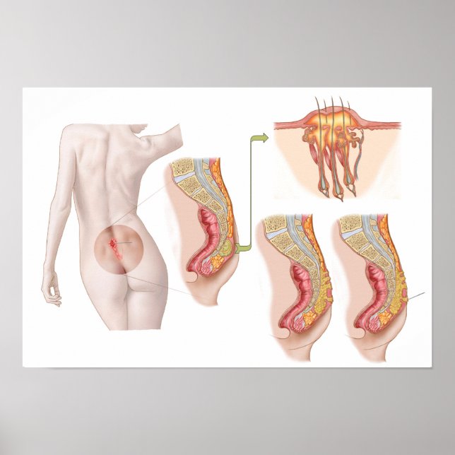 Medical Ilustration Of A Pilonidal Cyst Poster (Front)