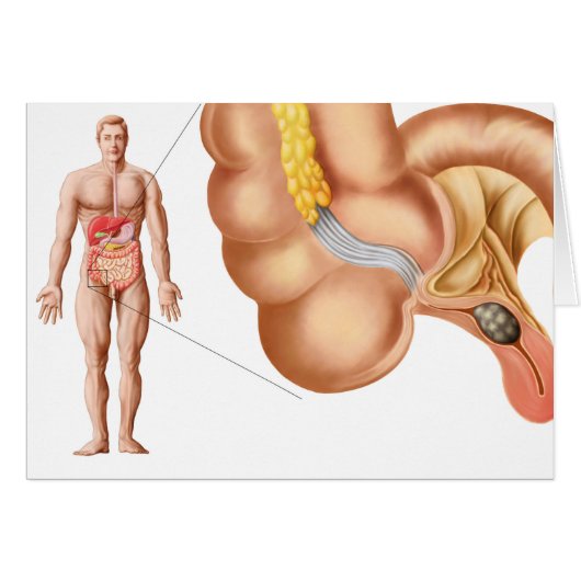 Medical Ilustration Of An Appendix Cards (Front Horizontal)