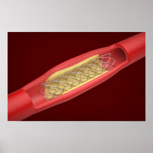 Medical stent inside blood vessel poster