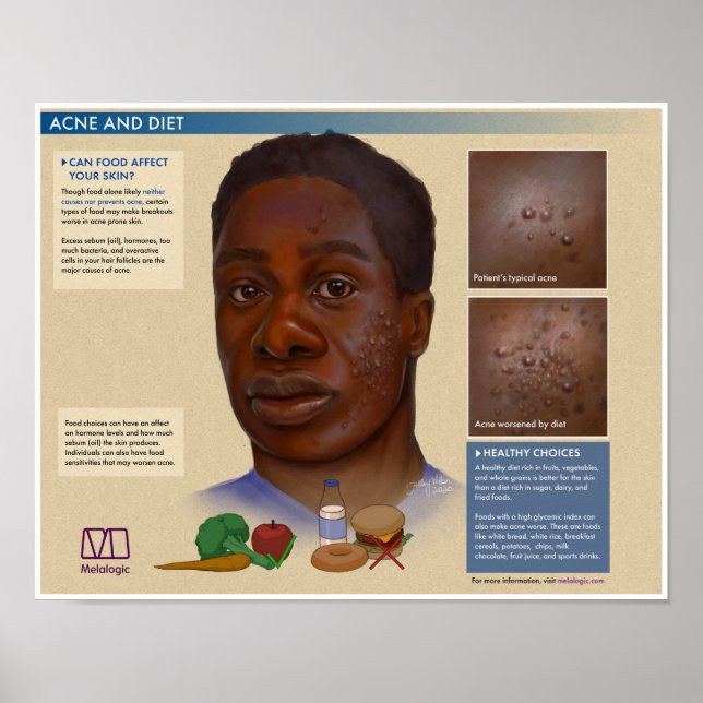 Melalogic Acne and Diet Medical Poster (Front)