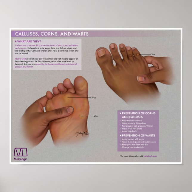 Melalogic Calluses, Corns and Warts Medical Poster (Front)