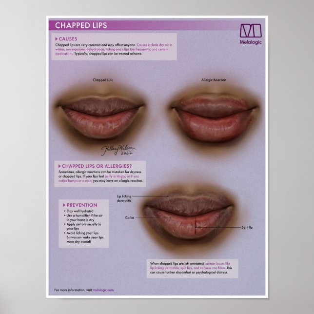 Melalogic Chapped Lips Medical Poster (Front)