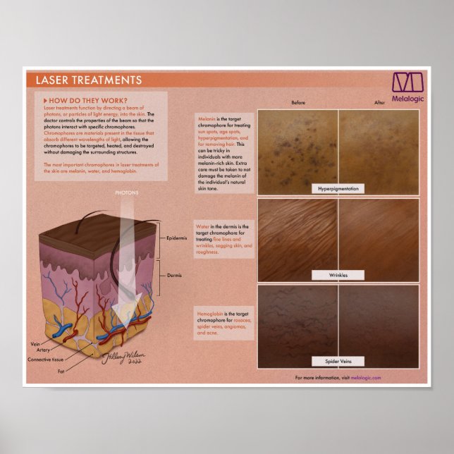Melalogic Laser Treatment Medical Poster (Front)