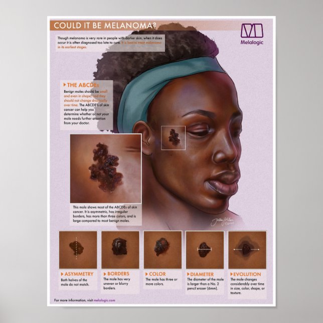 Melalogic Melanoma Medical Poster (Front)