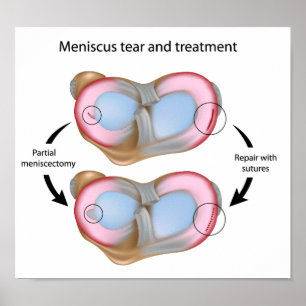 Meniscus tear and surgery Poster