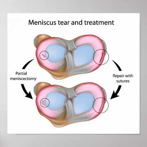 Meniscus tear and surgery Poster | Zazzle