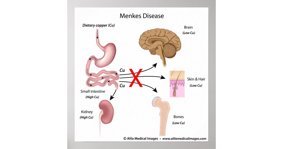 of 6 iphone diagram buttons Zazzle.com  syndrome,  poster labeled diagram. Menkes