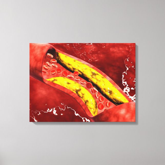 Microscopic View Of Fat Plaque Inside The Artery Canvas Print (Front)