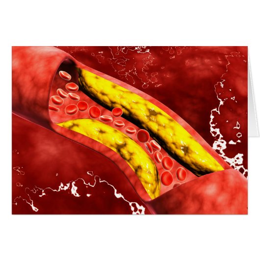 Microscopic View Of Fat Plaque Inside The Artery Cards (Front Horizontal)