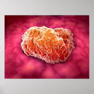 Microscopic View Of Tumor 3 Poster