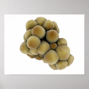 Microscopic View Of Tumor 5 Poster