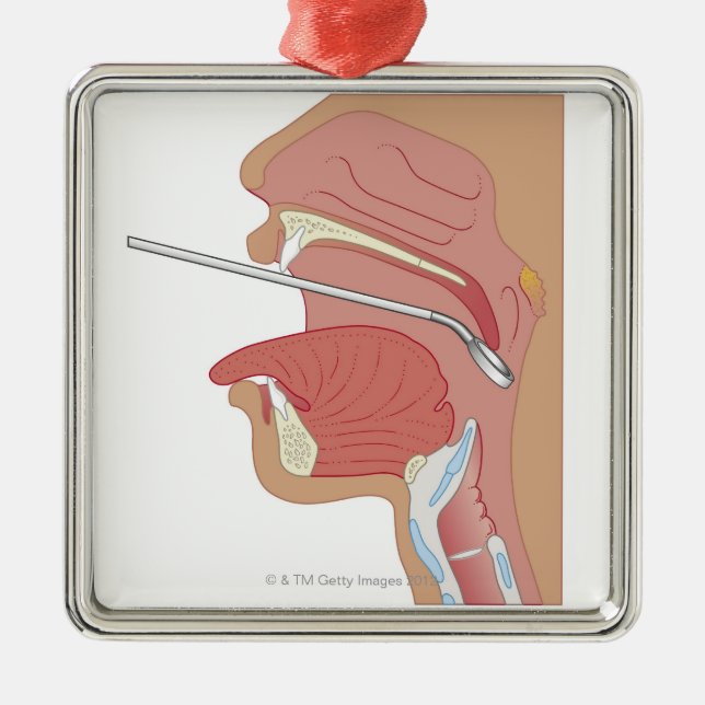 Mirror Laryngoscopy Metal Ornament (Front)