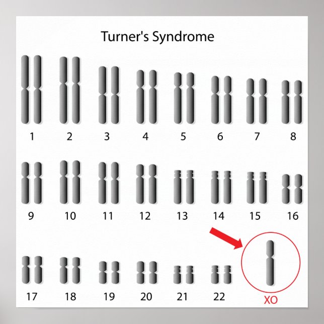 Monosomy X, Turner's syndrome Poster (Front)