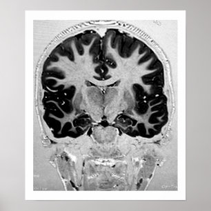 MRI Head Poster