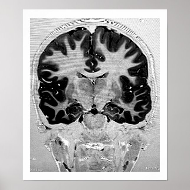MRI Head Poster (Front)