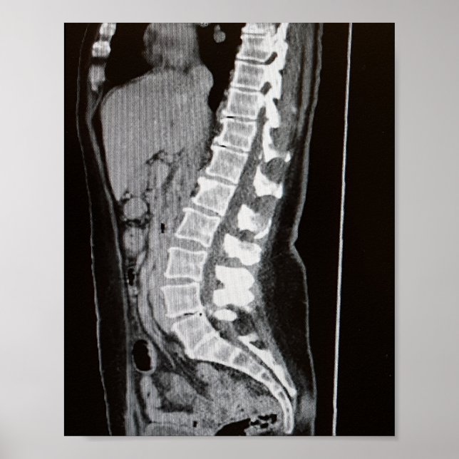 MRI of the Spine Poster (Front)