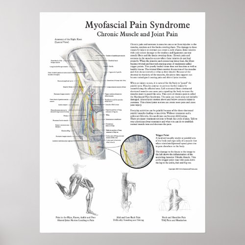 Myofascial Pain Syndrome Poster