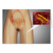 Narrowed Artery Near Leg Close-up (Front Horizontal)