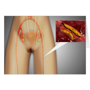 Narrowed Artery Near Leg Close-up Cards