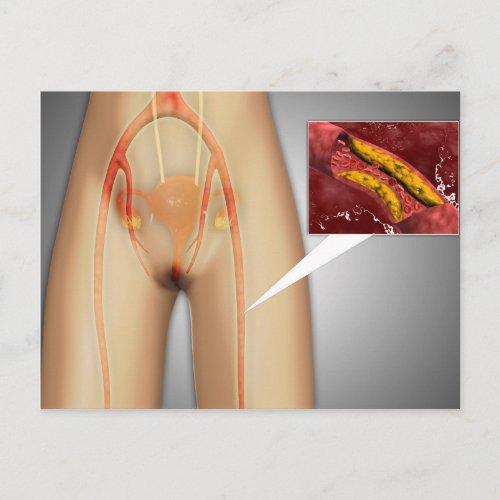 Narrowed Artery Near Leg Close_up Postcard
