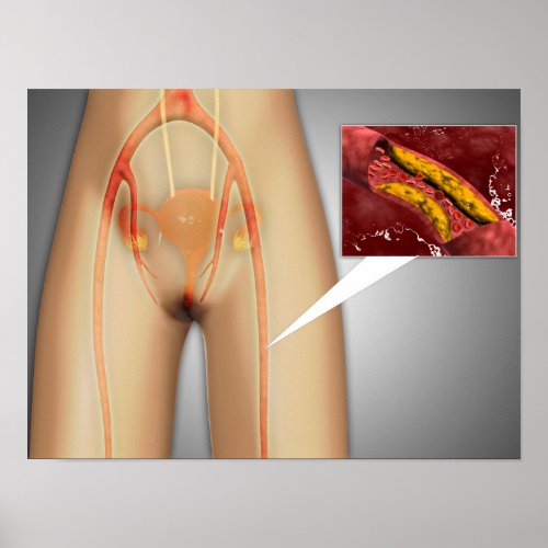 Narrowed Artery Near Leg Close_up Poster