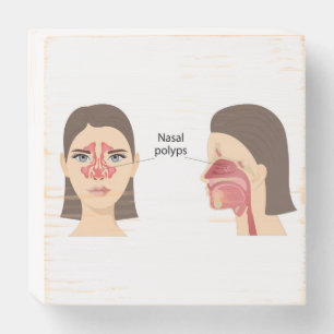Nasal polyps Wooden Box Sign