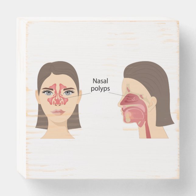  Nasal polyps Wooden Box Sign (Front Horizontal)