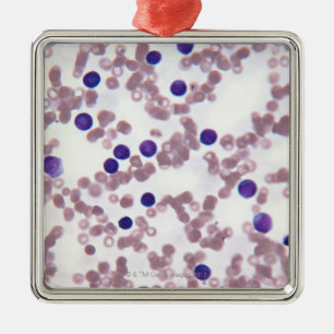 Neoplastic Lymphocyte Cells Metal Ornament