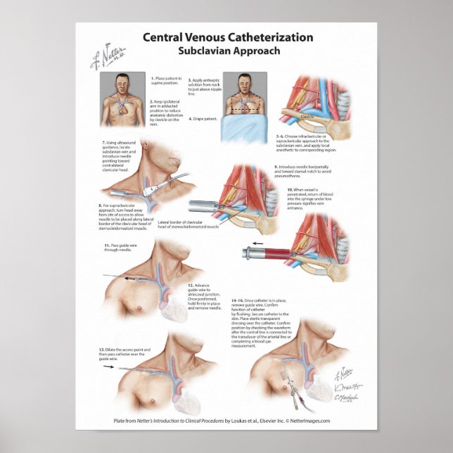 Netter Chart: Central Venous Catheterization Poster (Front)