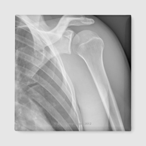 Normal shoulder X_ray of the healthy left Magnet