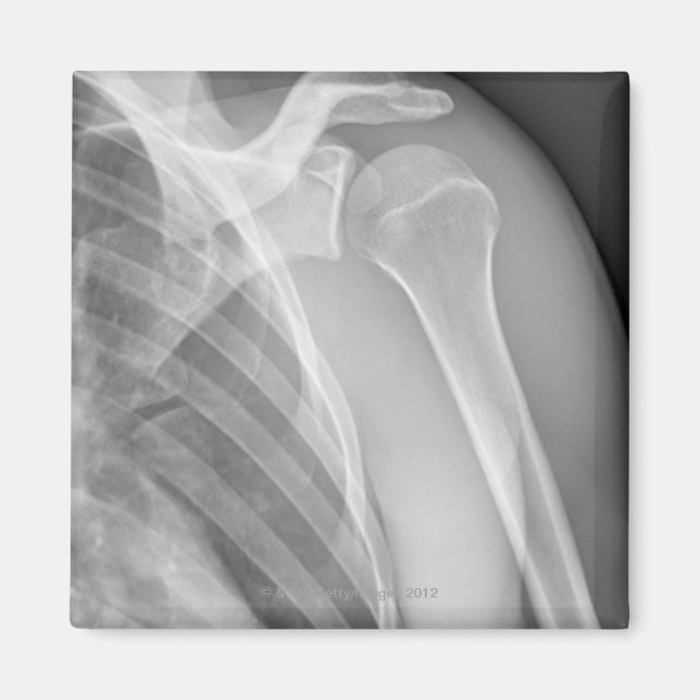 Normal shoulder. X-ray of the healthy left Magnet (Front)