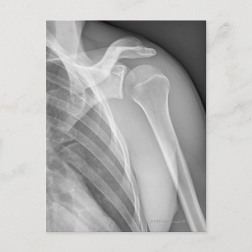 Normal shoulder X_ray of the healthy left Postcard