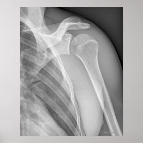 Normal shoulder X_ray of the healthy left Poster