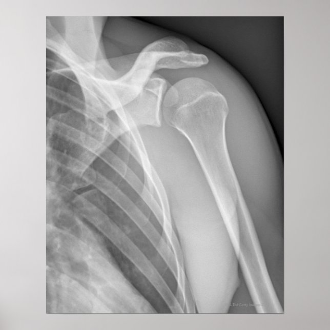 Normal shoulder. X-ray of the healthy left Poster (Front)