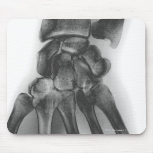 Normal wrist X_ray Mouse Pad