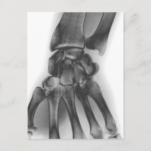 Normal wrist X_ray Postcard