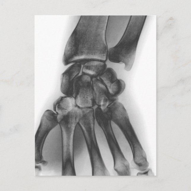 Normal wrist, X-ray Postcard (Front)
