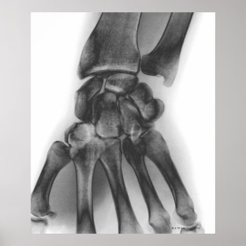 Normal wrist X_ray Poster