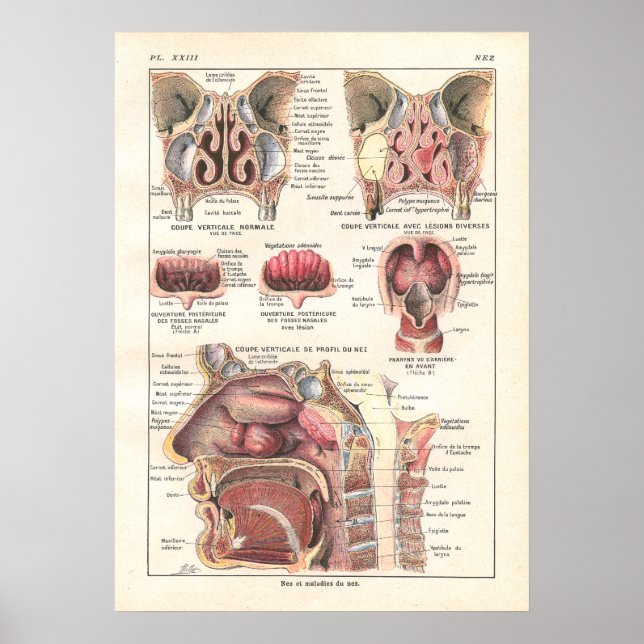Nose & Sinuses Anatomy Poster in French (Front)