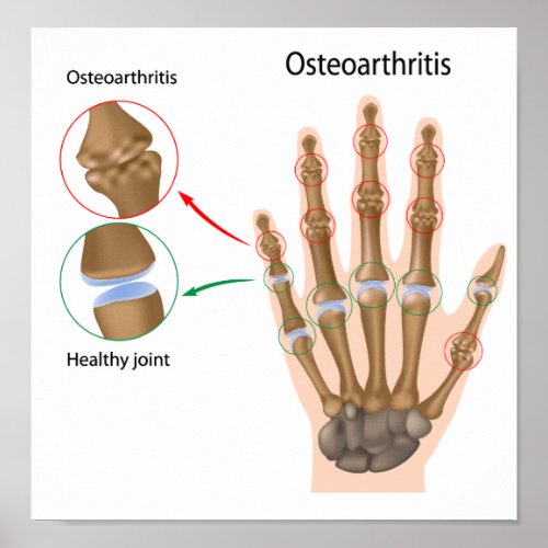 Osteoarthritis of the hand Poster