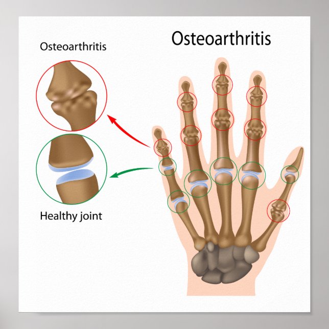 Osteoarthritis of the hand Poster (Front)
