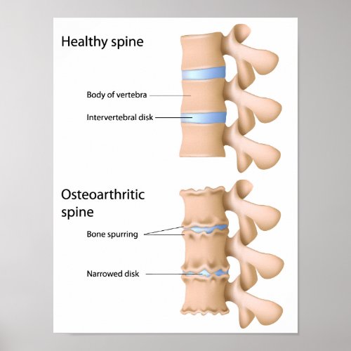Osteoarthritis of the spine Poster