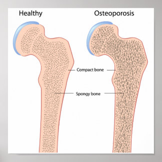 Osteoporosis Posters | Zazzle