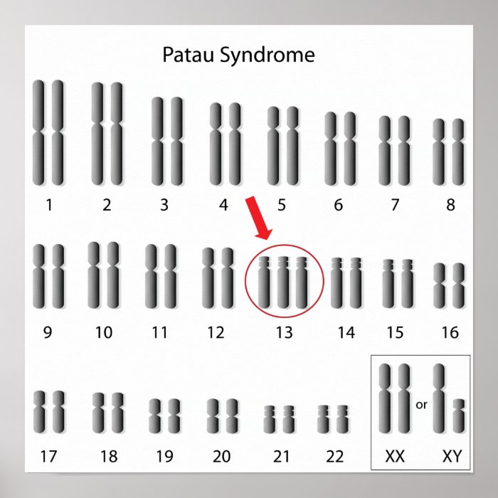 Patau syndrome, trisomy 13 Poster