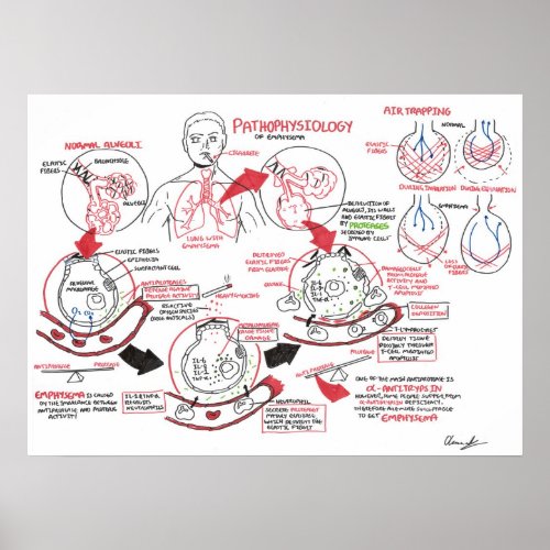 Pathophysiology of Emphysema Poster