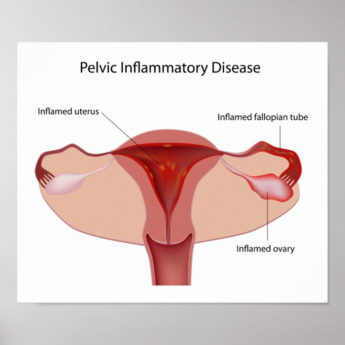 Pelvic inflammatory disease Poster